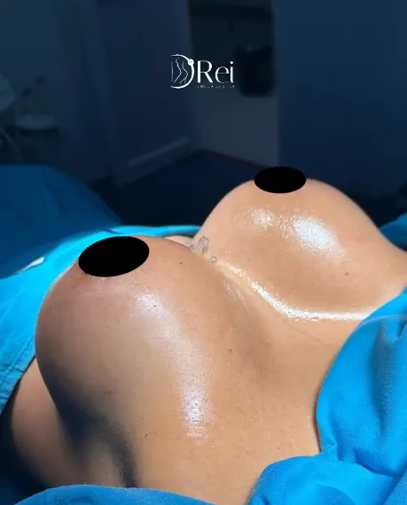 Mamoplastia portada_11zon